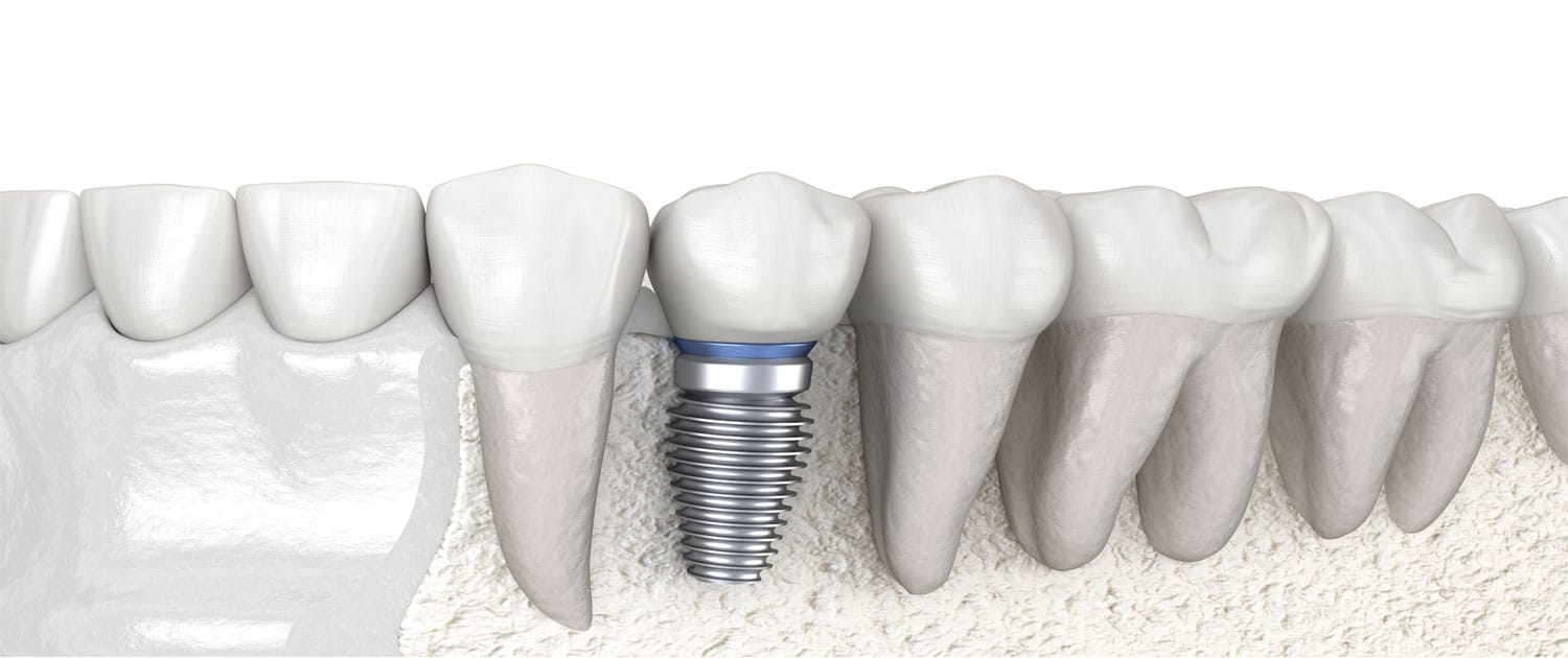 dentalimplants Golden Rule Dental